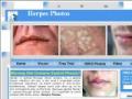 view herpes photos.